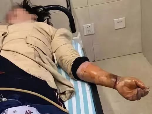 毒蛇咬伤截肢,毒蛇咬食指怎么处理