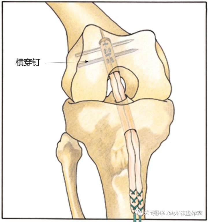 前交叉韧带断裂为什么没评上伤残,前交叉韧带断裂有什么症状