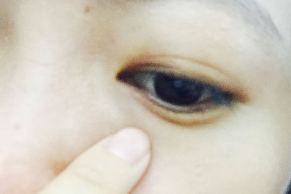 左眼眼皮一直跳动有什么征兆,眼皮一直跳预示什么疾病