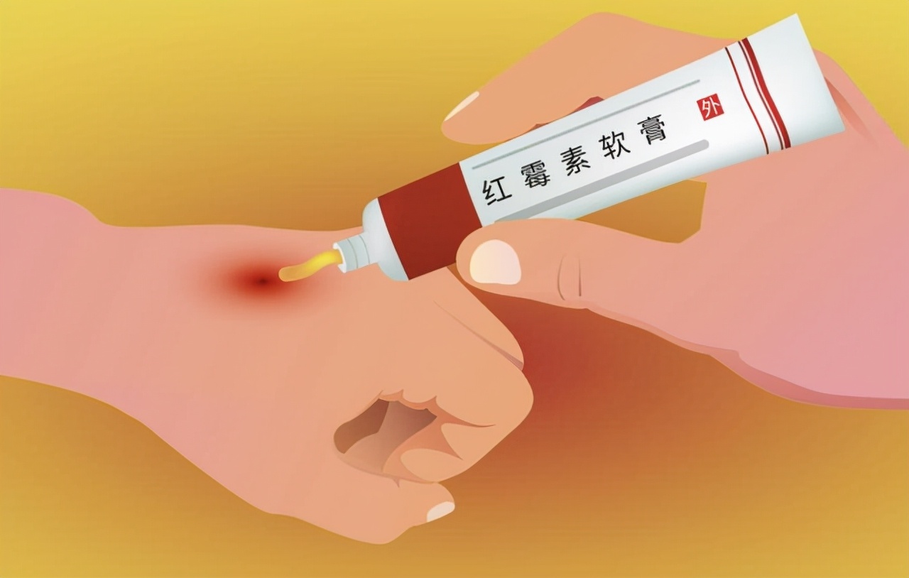 2块钱一支的红霉素软膏3个功效,红霉素软膏几块的和几十的区别