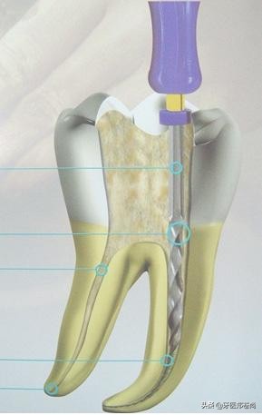 根管治疗有没有一次做完的,根管治疗要做手术吗