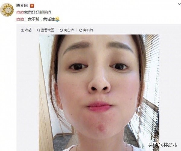 刘雨昕怕长痘吗,刘雨昕长痘的原因