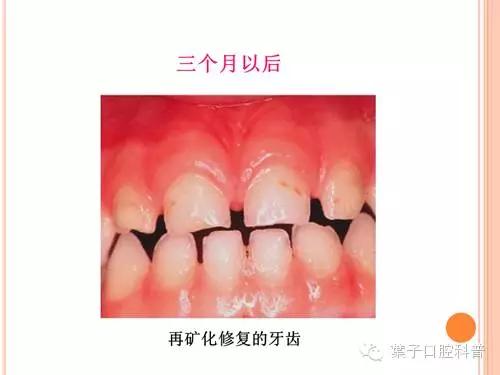 牙齿涂氟小知识,有氟牙可以涂氟吗