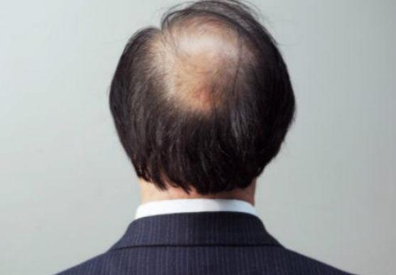 毛囊萎缩头发细软脱发,脂溢性脱发毛囊萎缩恢复正常了