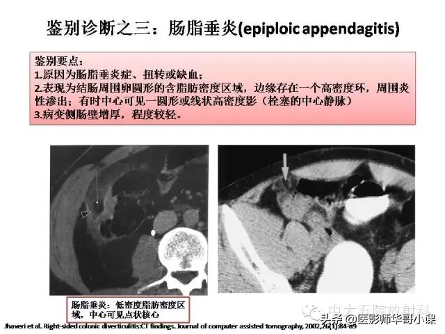 阑尾炎课件,阑尾炎的超声课件