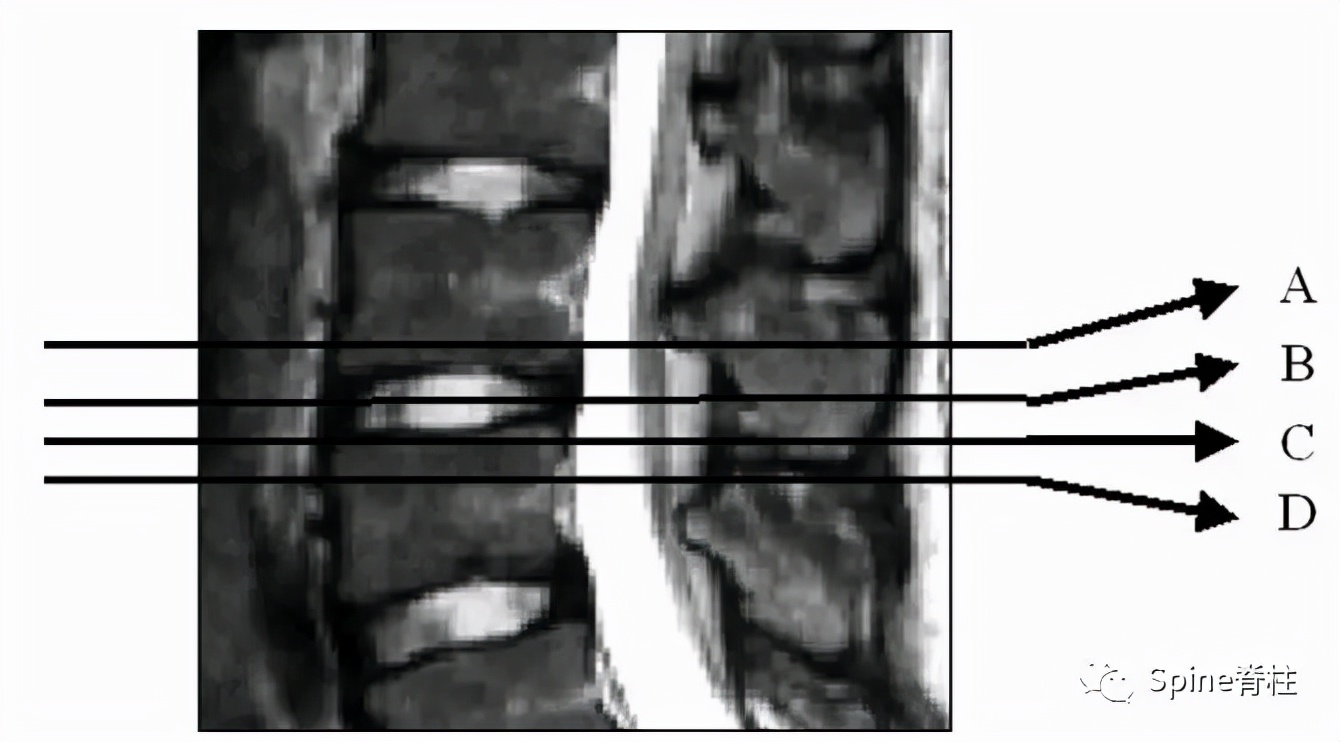 青少年一跑步就腰痛,青少年腰痛是什么原因引起的