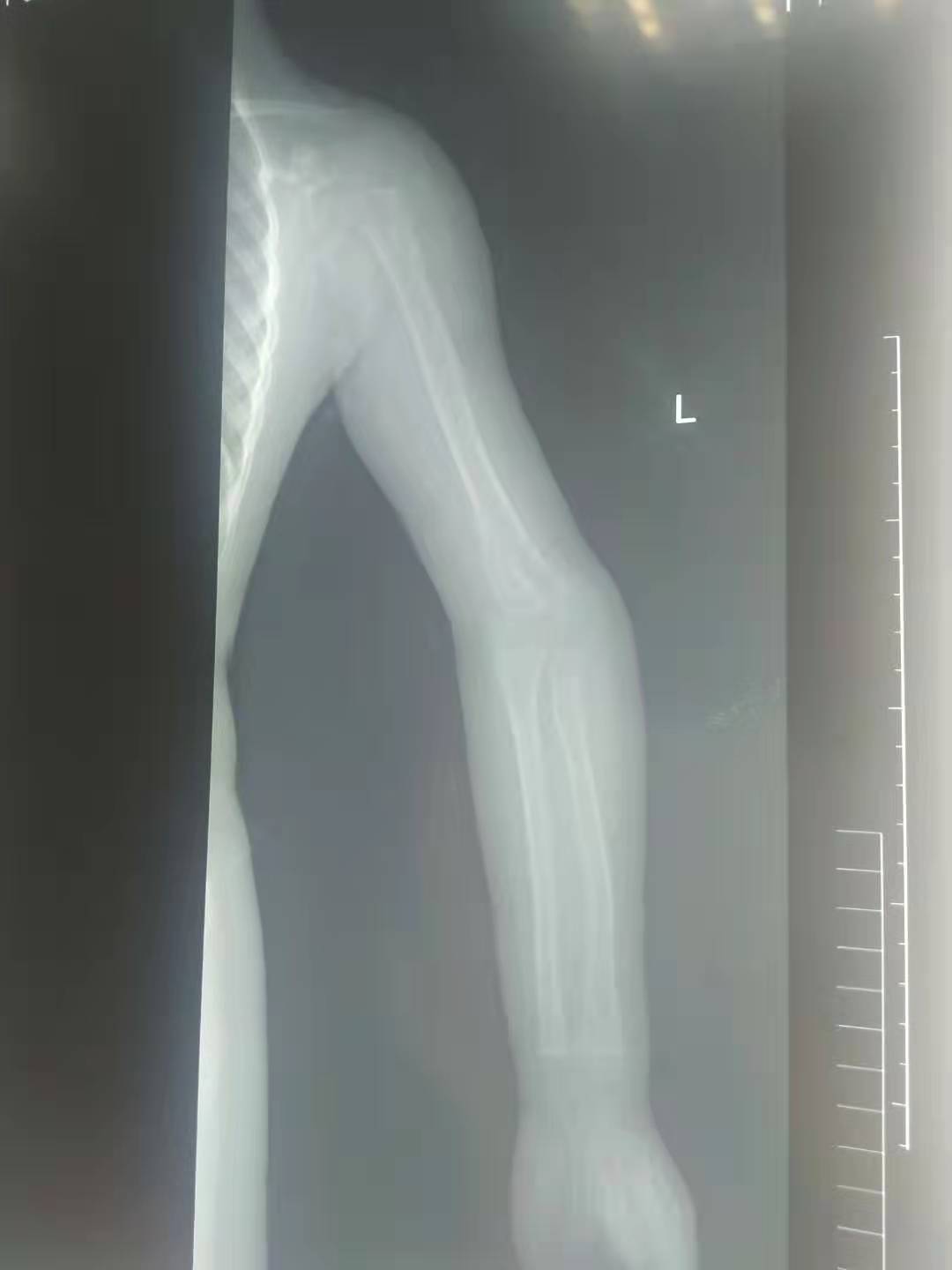 骨折复位错位1.4毫米有影响么,骨折错位一个月还能手法复位吗