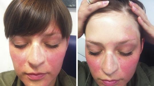 长斑了不用慌了解根源最重要,突然发现长斑了赶紧补救可以吗