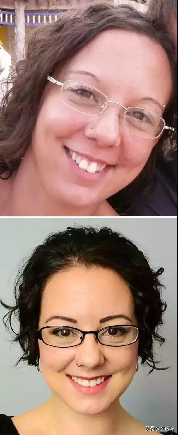 牙齿矫正换脸视频,牙齿矫正颜值有多大改变图片