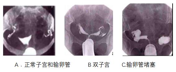 输卵管检查通液和造影哪个好,输卵管做通液好还是造影好