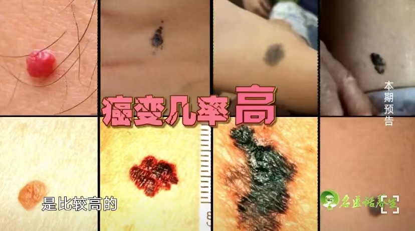 凸起的黑痣比较难去除吗,你身上有哪些奇特的痣