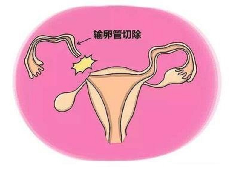 40天发现宫外孕怎么处理,怀孕40天发现是宫外孕