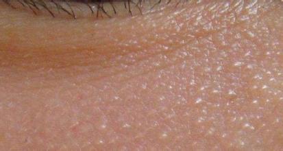 猫脂肪粒怎么消除,消除上眼皮脂肪粒