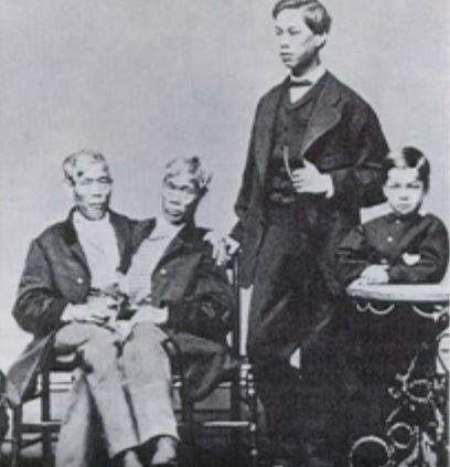 中国连体双胞胎兄弟,连体兄弟中国