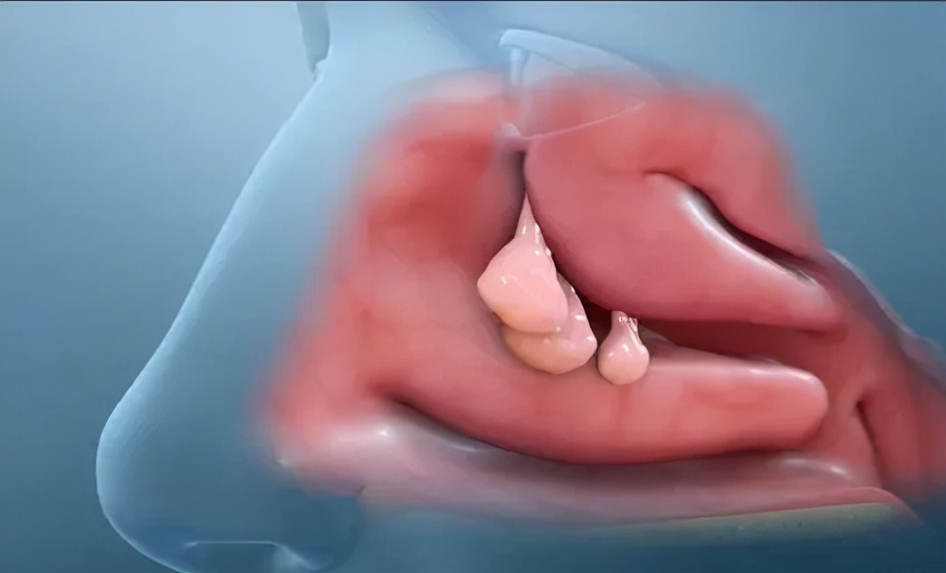 鼻息肉的症状及危害打呼噜,鼻息肉引起的鼻窦炎的症状及危害