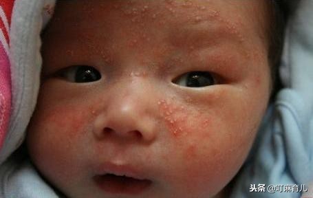 孕妈妈也会有黄疸吗,孕妈妈有湿疹对宝宝有影响吗