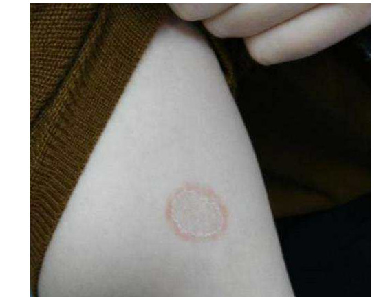 猫咪得了猫癣怎么治最有效,猫咪得了猫癣怎么治疗好得快一些