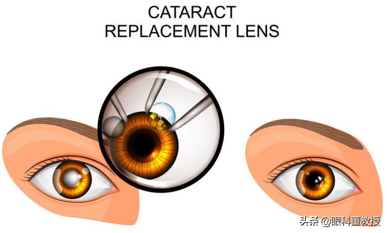 晶体脱落可以用什么药,换晶体后晶体脱落怎么办