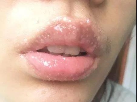 纹绣师怎么处理纹唇后肿,纹绣师漂唇过程发朋友圈