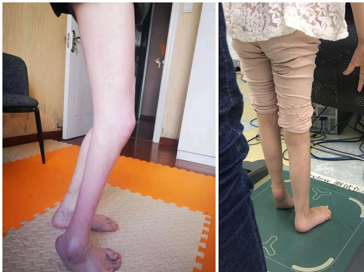 小儿足外翻穿矫正鞋,脑瘫尖足矫正鞋