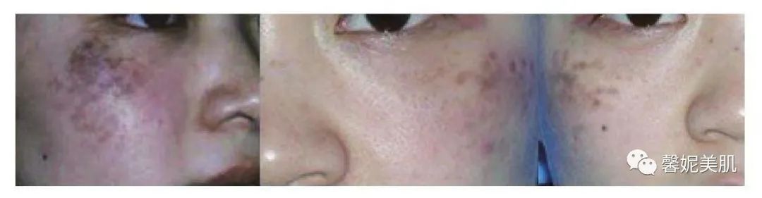 褐青色痣和太田痣区别,褐青色痣是太田痣吗