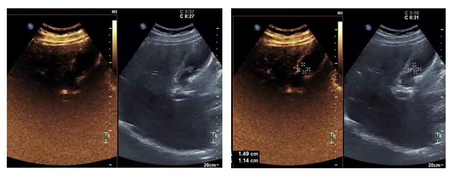 胆囊息肉消融保胆有效吗,胆囊息肉消融保胆有用吗