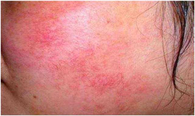 血丝多怎么办,血丝红是怎么回事