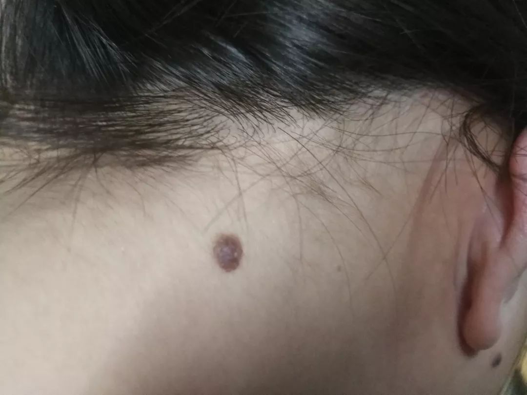 医生黑痣,医生长在摩擦部位的黑痣要当心