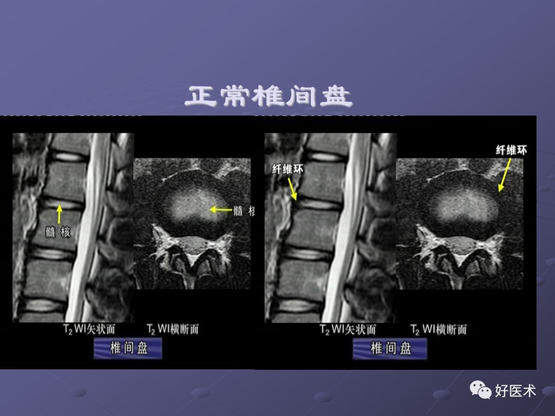 脊柱mri有哪些特点,乳腺疾病的mri诊断及鉴别