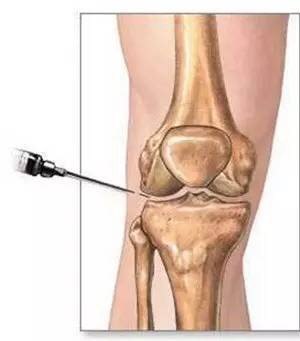 磁共振怎么看半月板损伤程度,磁共振半月板损伤1级是什么