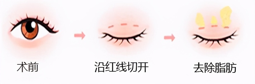 上眼皮松弛怎么锻炼,上眼皮下垂松弛严重