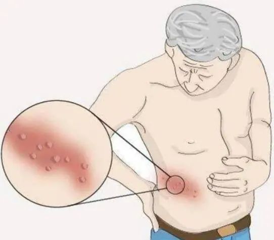 常州带状疱疹疫苗,带状疱疹疫苗在江苏哪里可以打