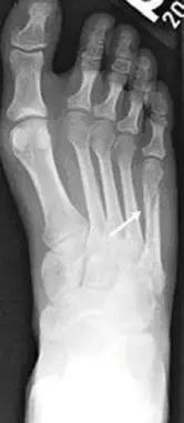 几种严重骨折医学名称,常见的骨折有哪些名称