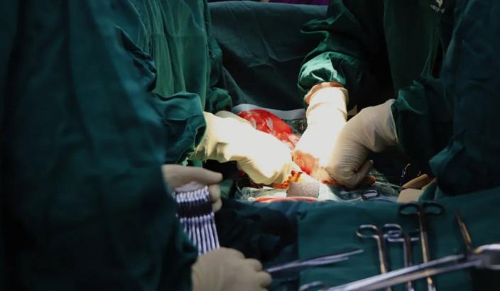 膀胱癌全切再造新膀胱并发症,膀胱全切输尿管皮肤造口术