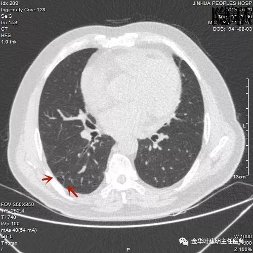 警惕-会是简单的肺大泡吗？