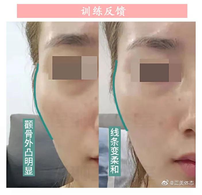 两边颧骨不一样大小如何调整,如何判断颧骨外扩还是颧骨突出