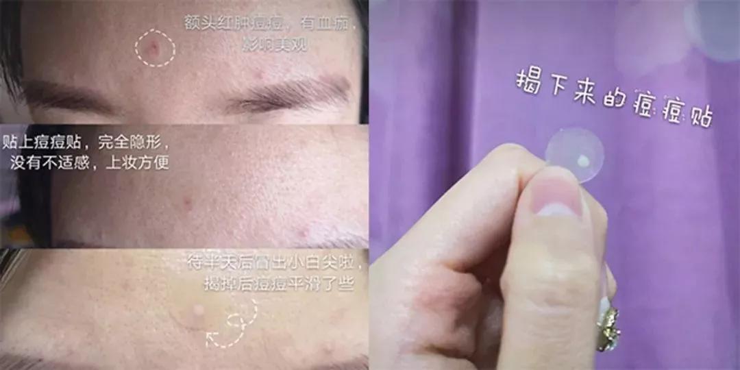 脸上老是长痘痘用什么药,脸上痘痘反复最快的解决方法