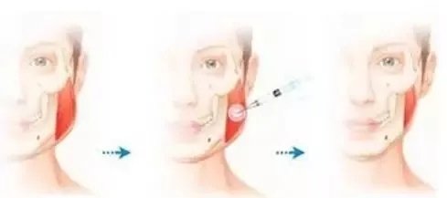 打瘦脸针10天脸下垂,瘦脸针造成的苹果肌没了会恢复吗