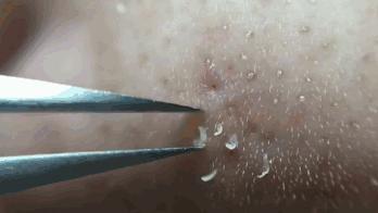 亲测真正有效去黑头粉刺产品,黑头连根拔起还会再长吗