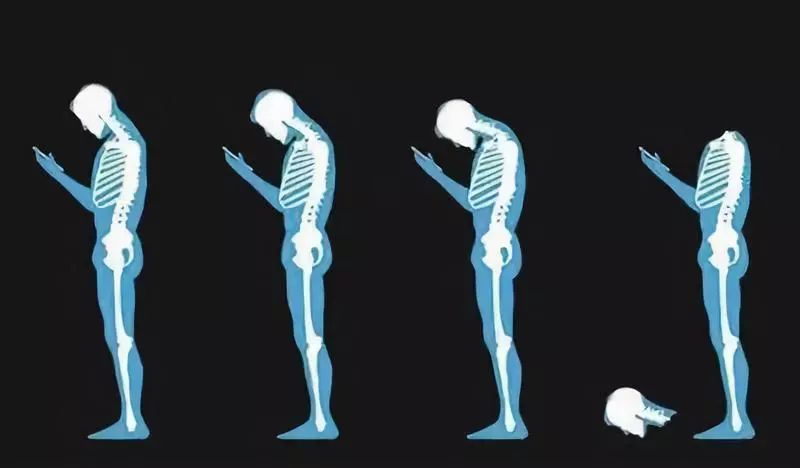 每天玩手机超过9小时,玩手机导致的颈椎病如何能治愈