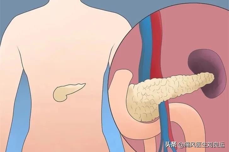 痛风和高血糖,痛风跟血糖高适合吃什么