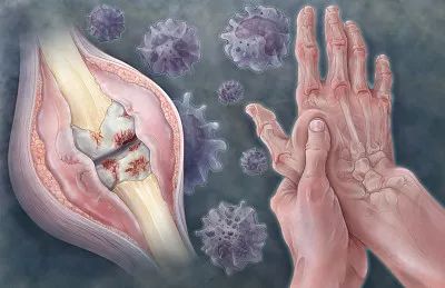 肩颈疼痛膏日本,澳洲缓解关节疼痛霜