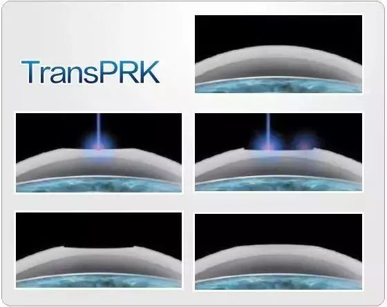 800度近视做飞秒手术还是晶体植入,800度的近视怎么治