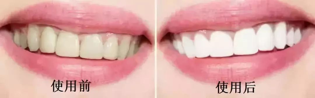 黄牙口臭的克星,牙黄口臭用什么牙膏有效果一点