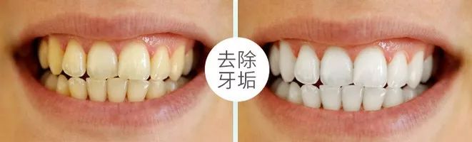 黄牙口臭的克星,牙黄口臭用什么牙膏有效果一点