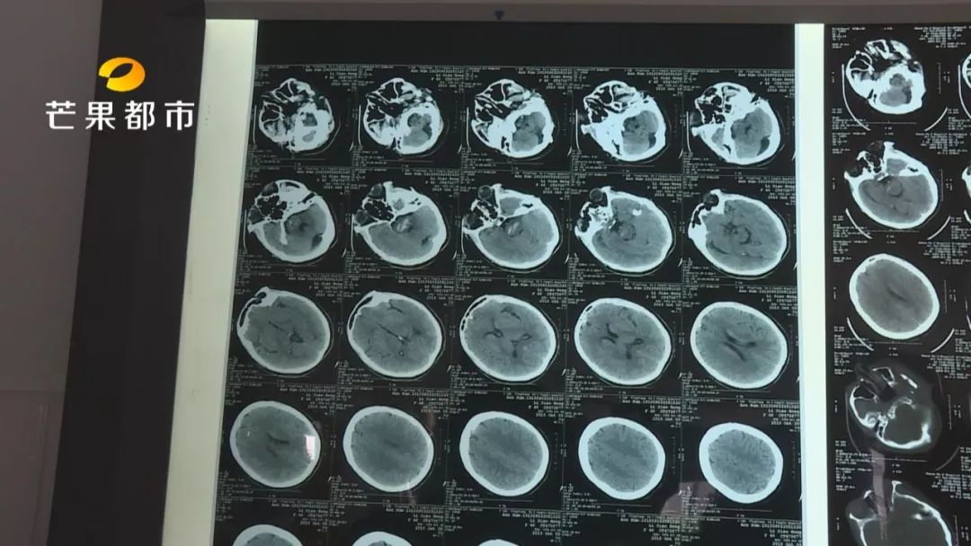 打麻将脑溢血,打麻将突发脑溢血抢救