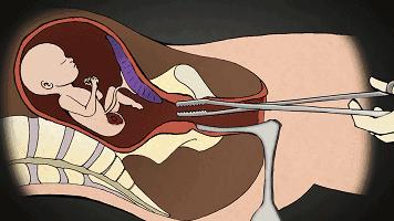 多次打胎真实案例,25岁女生接受多少次打胎