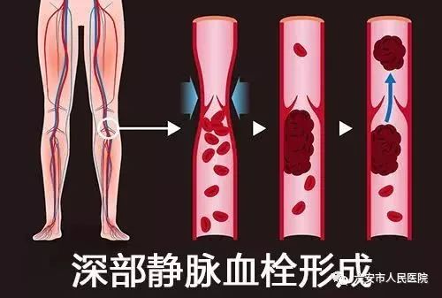 「健康」一天打7个多小时麻将！六安刘女士的腿肿成“大象腿”……
