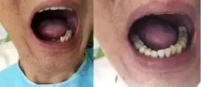 今年种植牙齿进医保了吗,矫正牙齿不给报销吗