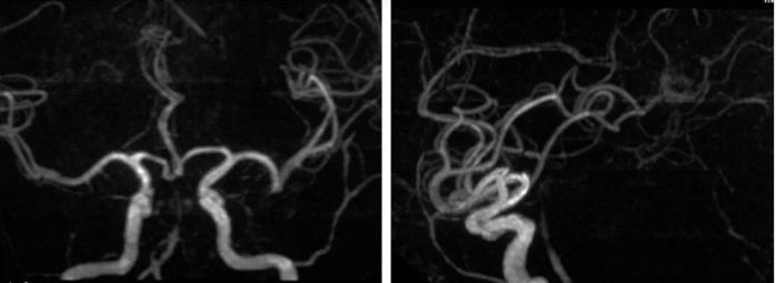 椎动脉起始段狭窄的介入治疗ppt,椎动脉v4段假性动脉瘤介入治疗